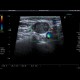 Lateral cervical cyst, complicated: US - Ultrasound